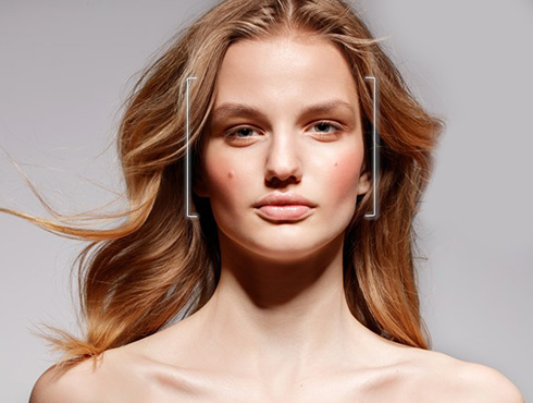 melasma